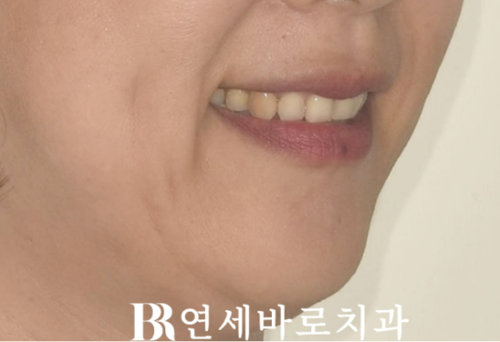 역류성 식도염으로 갈린 치아&hellip; 무삭제 라미네이트로 자연스럽게 회복 관련 이미지 2