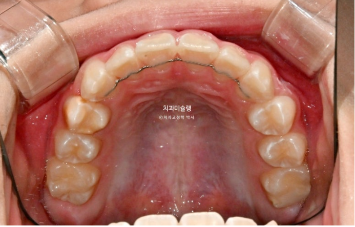 어린이 돌출입 교정 무턱 투명교정 인비절라인 퍼스트 관련 이미지 17