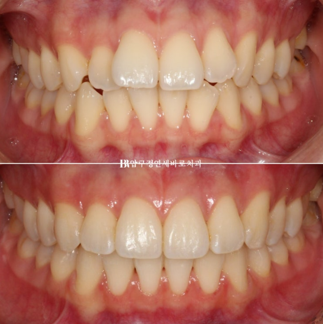 Orthodontic Treatment for International Students: Is Short-Term Treatment Possible in Korea? | A Real 5-Month Front Teeth Partial Orthodontic Case image 9