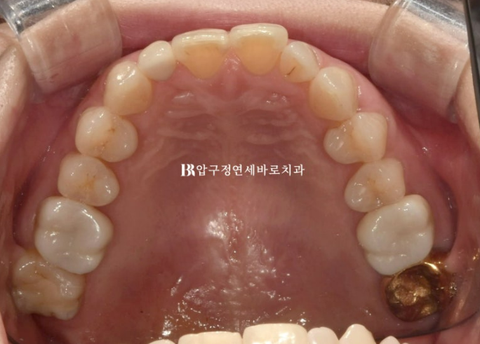 Invisalign Lite for Orthodontic Treatment in Your 40s: Crossbite and Protrusive Mouth Correction image 5