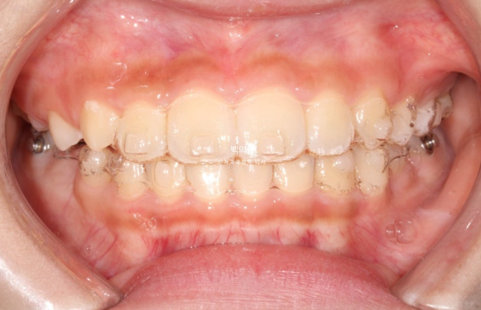 인비절라인퍼스트 어린이 투명교정 과개교합 덧니 악궁확장 돌출 관련 이미지 15