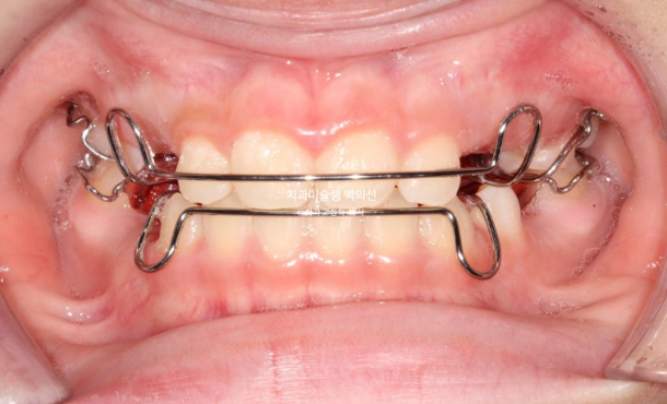 어린이 비대칭 반대교합 주걱턱 인비절라인 퍼스트 프리올소 성장 교정 관련 이미지 24