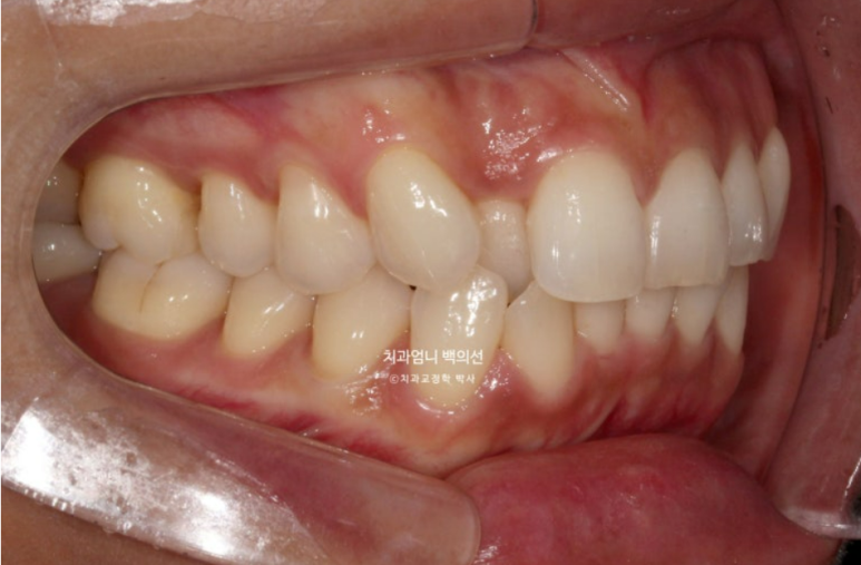 인비절라인 비발치 덧니 교정 반대교합 치료 후기 관련 이미지 3