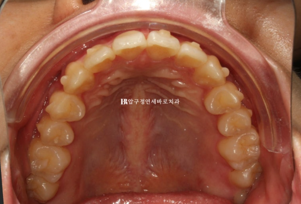 토끼이 교정, 인비절라인 익스프레스로 가능할까?앞니 부분교정 4개월 치료 증례 소개 관련 이미지 8