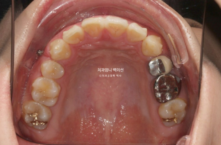 돌출입 발치 교정 인비절라인 후기 미니스크류 관련 이미지 10