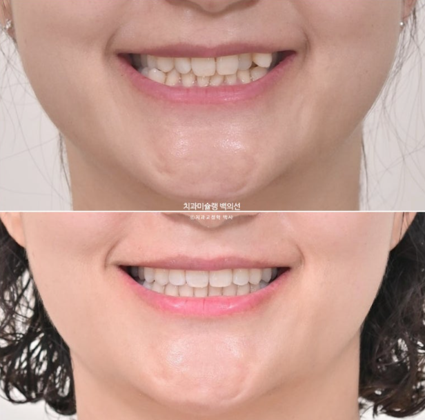 옥니 덧니 과개교합 반대교합 중심선 인비절라인 치료기간 1년 관련 이미지 18