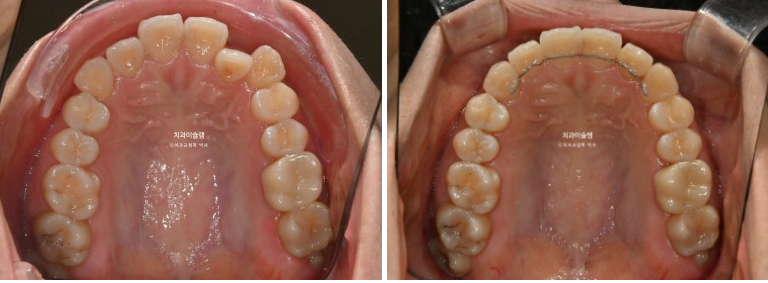 인비절라인 라이트 반대교합? 덧니 중심선 치간삭제 치료 관련 이미지 13