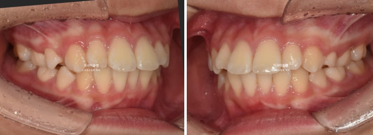 돌출입 비발치 어린이 교정 입술부전증 호두주름 호두턱 토끼이빨 인비절라인퍼스트 관련 이미지 3