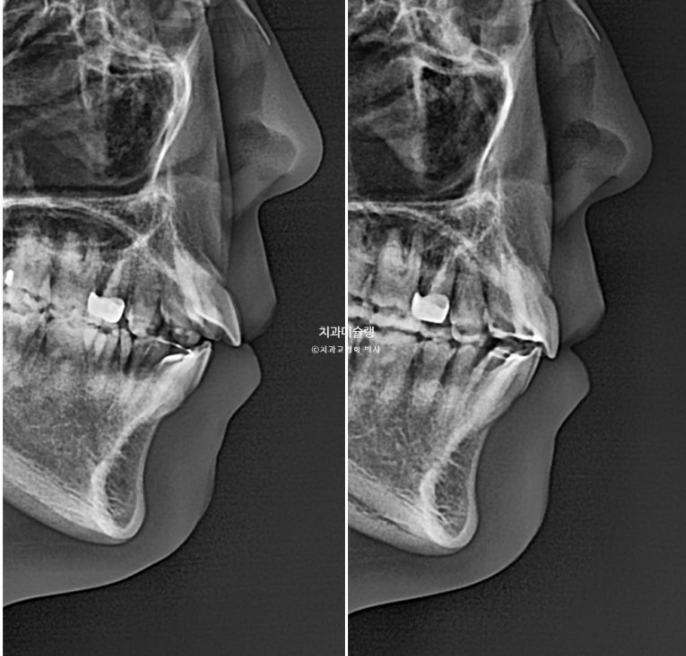 비발치 인비절라인 교정 편측 개방교합 가위교합 돌출 재교정 관련 이미지 26