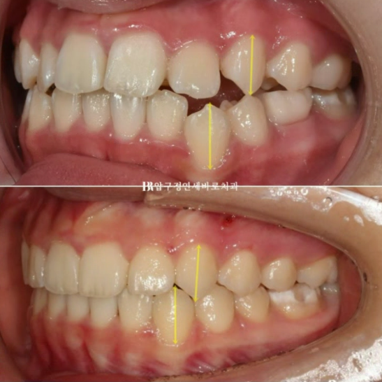 어린이 투명교정 인비절라인 틴 덧니 교정 후기 관련 이미지 11