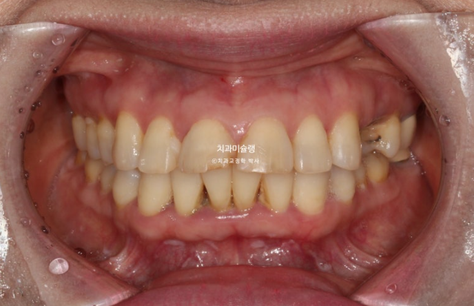 50대 치아교정 돌출 치아벌어짐 중년교정 관련 이미지 2