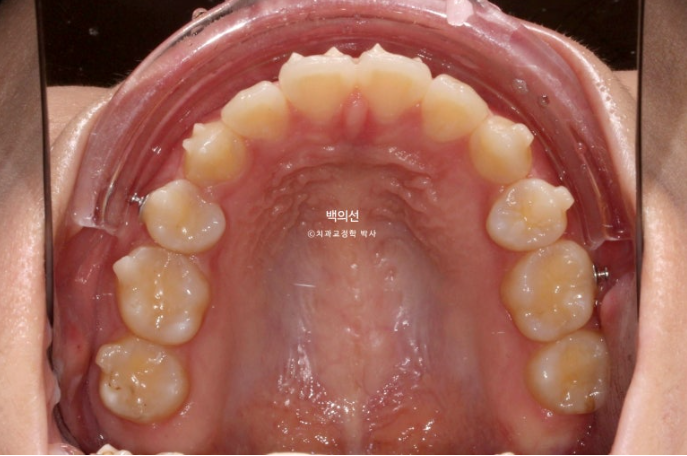 돌출입 교정 인비절라인 발치 교정 개방교합 치료 후기 관련 이미지 10