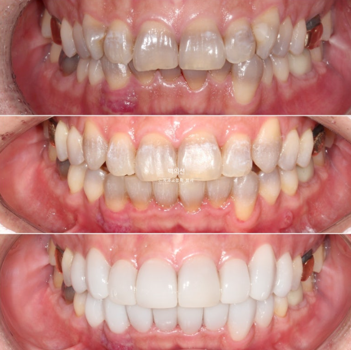 Treatment Review: No-Prep Laminate for Tetracycline-Stained Teeth image 16