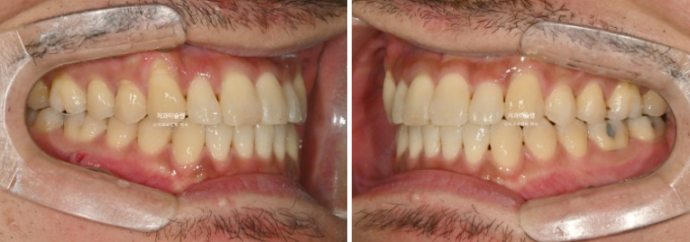 30대 MSE 악궁확장 덧니 반대교합 비발치 클리피씨 부작용 관련 이미지 14