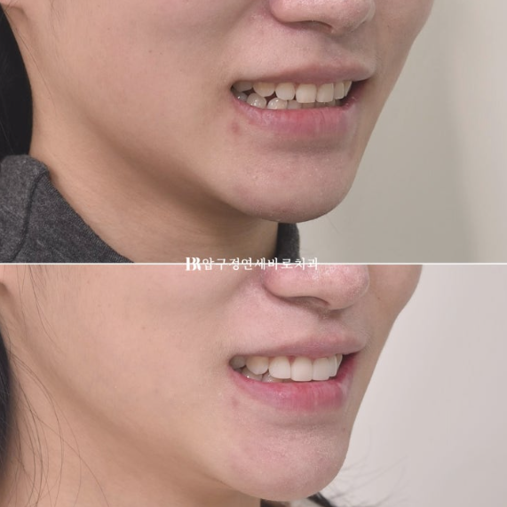 If Your Front Teeth Look Spaced Due to Peg-Shaped Teeth or Microdontia: A Case Choosing No-Prep Veneers Instead of Orthodontic Treatment image 10