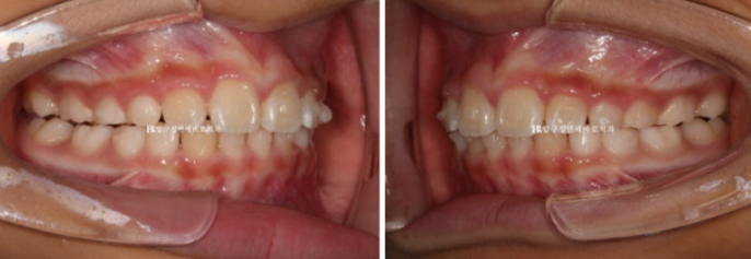 무턱교정 어린이 투명교정 인비절라인 퍼스트 교정 후기 관련 이미지 6