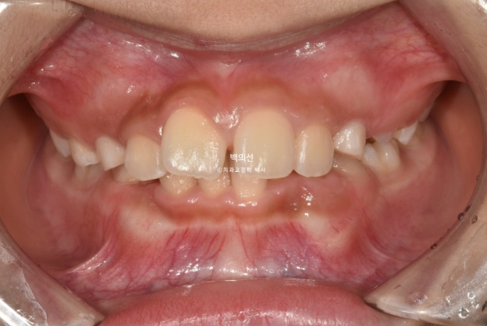 인비절라인퍼스트 어린이 투명교정 과개교합 덧니 악궁확장 돌출 관련 이미지 2