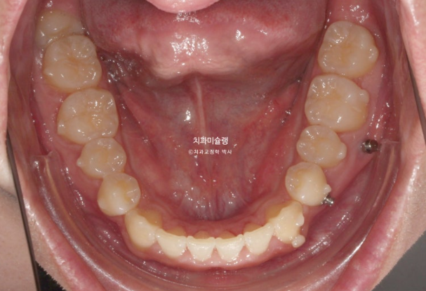 비대칭 비발치 거미스마일 잇몸미소 중심선 가위교합치료 무삭제 라미네이트 관련 이미지 13