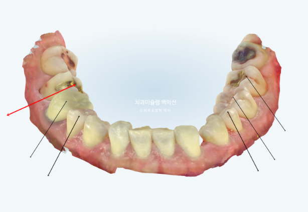 해외거주 앞니 선천적 결손 과개교합 인비절라인 라이트 브릿지 치료 관련 이미지 5