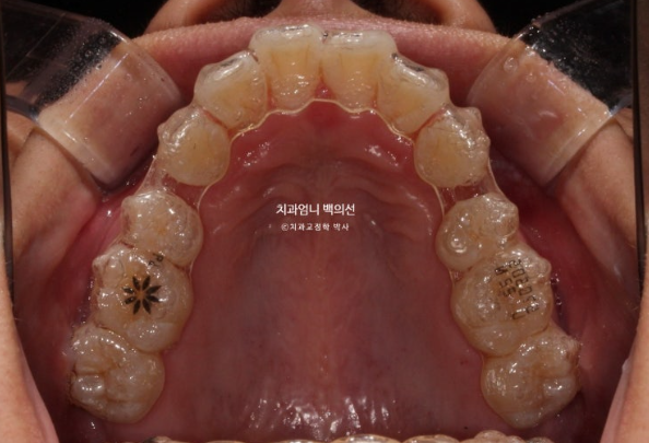 돌출입 교정 인비절라인 발치 교정 후기 관련 이미지 7