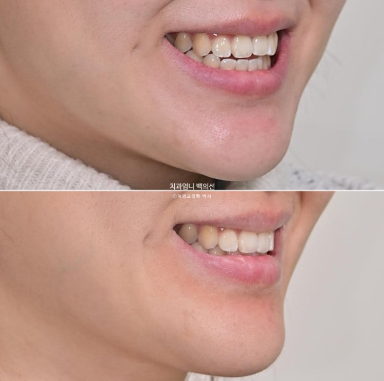 앞니 단기 부분교정 재교정 개방교합 교정 후기 관련 이미지 16