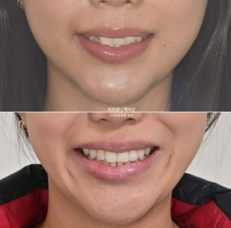 인비절라인 비발치 덧니 교정 반대교합 치료 후기 관련 이미지 18