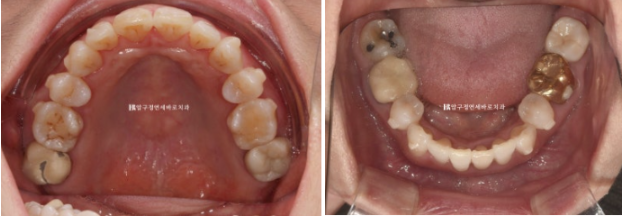 50대 중년교정 인비절라인 라이트 나비치아 교정 앞니 교정 후기 관련 이미지 8