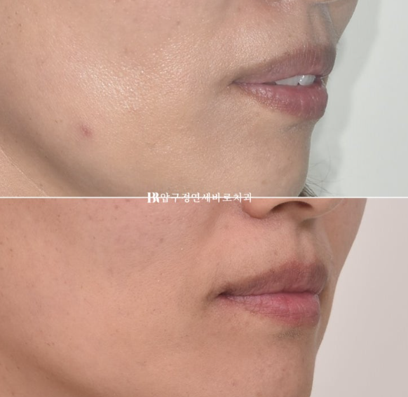40대 재교정 가능할까요? 비발치 돌출입 교정 호두턱 팔자주름 후기 관련 이미지 8