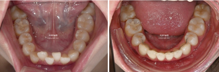 심한 돌출입 입술부전증 호두주름 발치교정 치료 관련 이미지 13