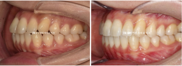 Invisalign Lite Treatment for Crossbite, Rabbit Teeth, and Protruding Front Teeth Correction image 9