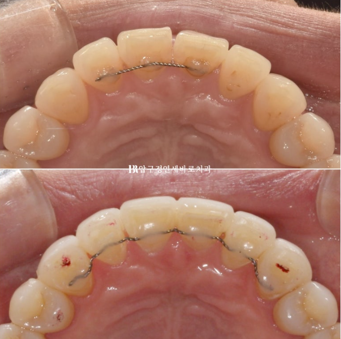 How to Avoid Regretting No-Prep Laminate Veneers: The Fitting Process Revealed image 8