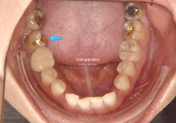 해외거주 앞니 선천적 결손 과개교합 인비절라인 라이트 브릿지 치료 관련 이미지 4