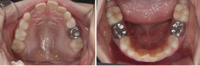A Real Case of Preventing Crowded Teeth with Invisalign First for a Child in Gangnam image 2