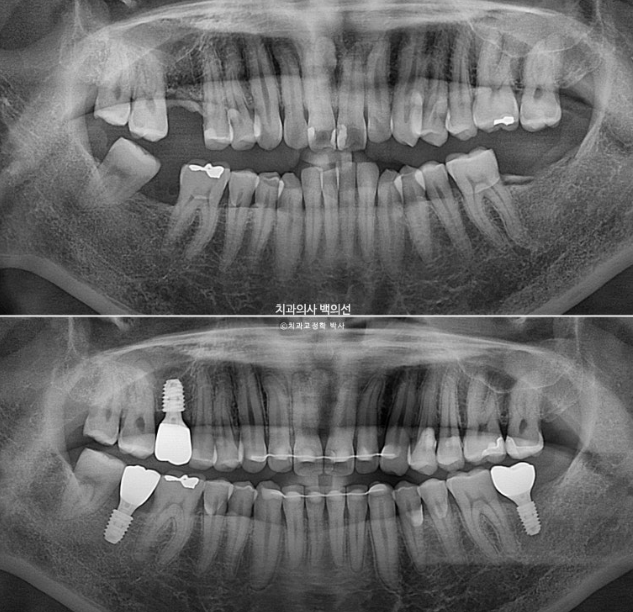 40대 인비절라인 라이트 과개교합 과잉치 덧니 교정 임플란트 보철 교정 후기 관련 이미지 22