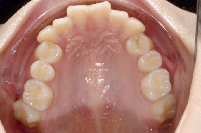 비발치 덧니교정 인비절라인 교정 사랑니 이용 교정 관련 이미지 3