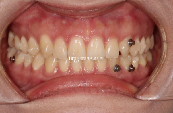 If Inward-Tilted Teeth Make Your Smile Look Constricted? Invisalign Before and After image 6