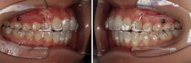 비발치 인비절라인 교정 돌출입 교정 후기 관련 이미지 6