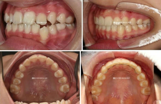어린이 투명교정 인비절라인 틴 덧니 교정 후기 관련 이미지 13