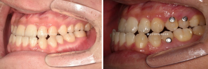 양악수술 교정 인비절라인 주걱턱 교정 치료 후기 관련 이미지 6