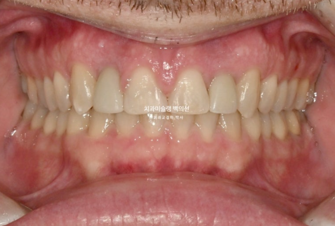 앞니 선천적 결손 인비절라인 임플란트 과개교합 치료 기간 관련 이미지 22