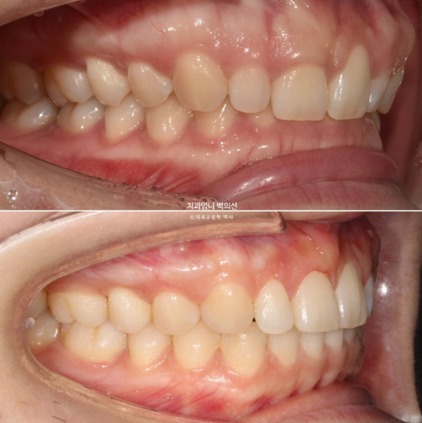 거미스마일 과개교합 교정 잇몸돌출 잇몸 비대칭 관련 이미지 15
