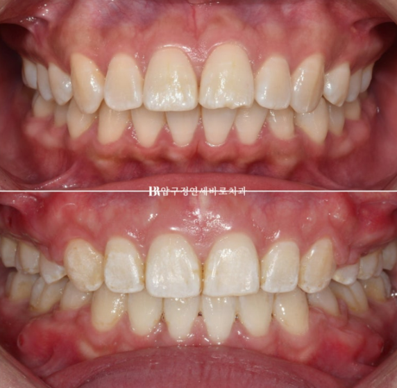 A Review of Extraction Orthodontic Treatment for Protruding Mouth | The Details of Orthodontics That Transform Buccal Corridors and Smile Lines image 11