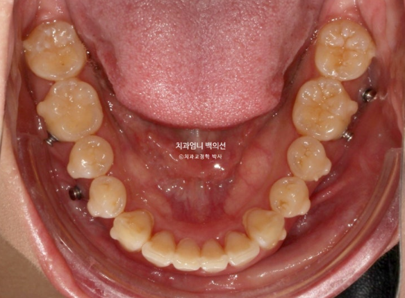 돌출입 교정 인비절라인 발치 교정 후기 관련 이미지 12