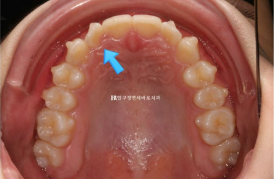 서울 인비절라인 덧니 교정 과개교합 후기 관련 이미지 4