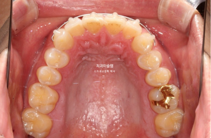 덧니 앞니 부분교정 급속교정 단기 MTA 미니튜브 기간 6개월 관련 이미지 7