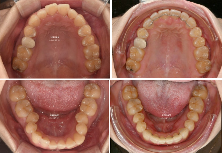비발치 인비절라인 교정 편측 개방교합 가위교합 돌출 재교정 관련 이미지 18
