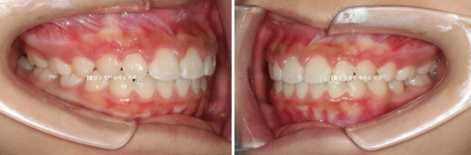 A Child’s Protruding Teeth Correction Review: Difficulty Closing the Lips image 12