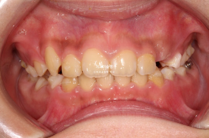 선천적 결손 잔존유치 과개교합 돌출입 인비절라인 퍼스트 어린이 투명교정 치료기간 관련 이미지 7