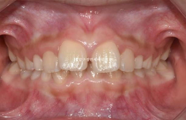 Invisalign First Correction for a Retruded Chin in a Child Orthodontic Treatment for Protrusion image 2