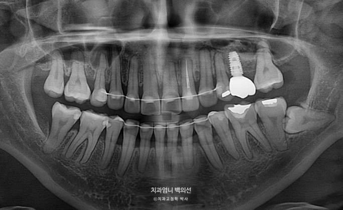 옥니 역교정 재교정 무턱 교정 치료기간 1년 10개월 관련 이미지 20